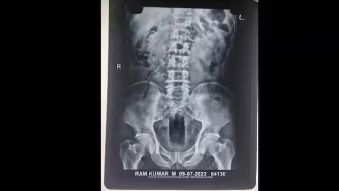 कमर के नीचे दर्द की शिकायत लेकर हॉस्पिटल पहुंचा मजदूर, डॉक्टरों ने X-ray निकाल कर देखा तो थम गई सांसे….