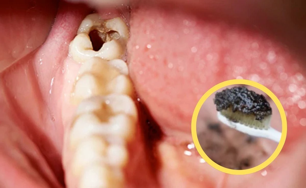दांतों में लगे कीड़े को कैसे खत्म करें? नेचुरल टूथपेस्ट का करें इस्तेमाल, डॉक्टर ने बताया कैसे बनाएं