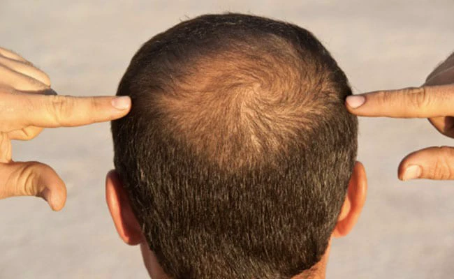 1 महीने तक लगाए, सरसों के तेल में ये एक चीज मिलाकर; गंजे सिर उगने लगेंगे नए बाल; नेचुरल तरीके से होंगे घने और लंबे......