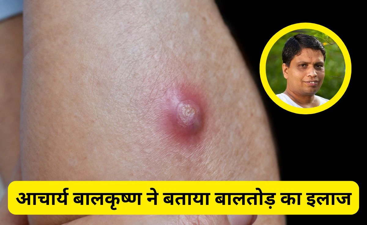 बालतोड़ का इलाज जल्दी कैसे करें? Acharya Balkrishna ने बताया कैसे ठीक होंगे ये फोड़े