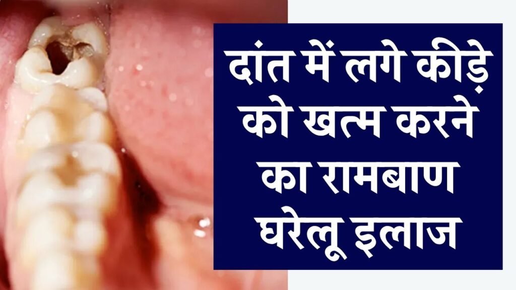 दांत का कीड़ा कैसे निकालें? कैविटी को खत्म करने के लिए रामबाण घरेलू उपाय