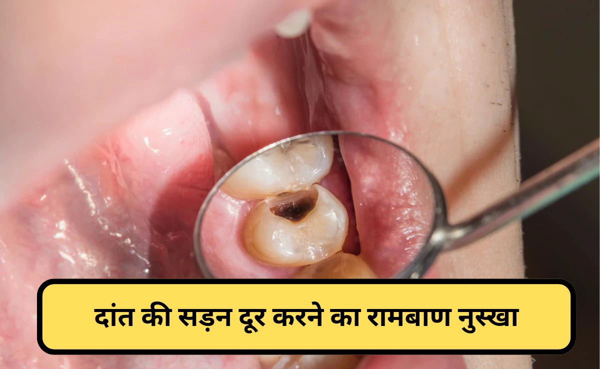 क्या दांत की कैविटी को प्राकृतिक रूप से ठीक किया जा सकता है? एक्सपर्ट ने बताया नुस्खा