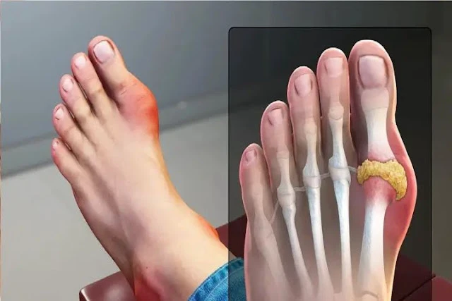 "यूरिक एसिड हो जाएगा जड़ से साफ, रोज खाएं ये 5 रुपये वाला फल!!"