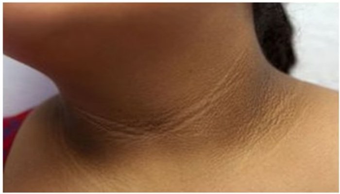 Obesity in Kids: गर्दन पर कालापन सिर्फ मैल नहीं, इस खतरनाक बीमारी की है शुरुआत!