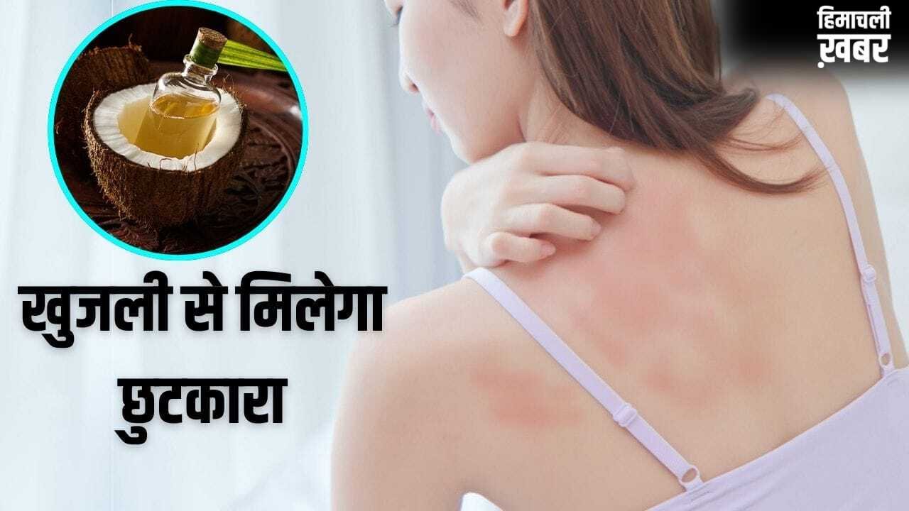 Summer Skin Care Remedy: गर्मी से हो रही खुजली-महीन दानों का होगा सफाया, नारियल तेल में मिलाकर लगा लें ये 1 चीज