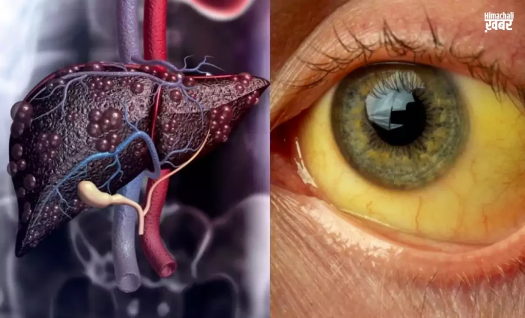 liver ko sada deti hai