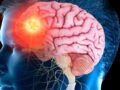 Brain stroke recovery : ब्रेन स्ट्रोक के बाद रिकवरी भी है जरूरी, डॉक्टर से जानें टिप्स