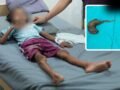 गोरखपुर में 7 साल की बच्ची के पेट से निकला बालों का गुच्छा, डॉक्टर भी रह गए हैरान; बाल खाने की आदत थी