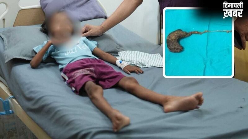गोरखपुर में 7 साल की बच्ची के पेट से निकला बालों का गुच्छा, डॉक्टर भी रह गए हैरान; बाल खाने की आदत थी​