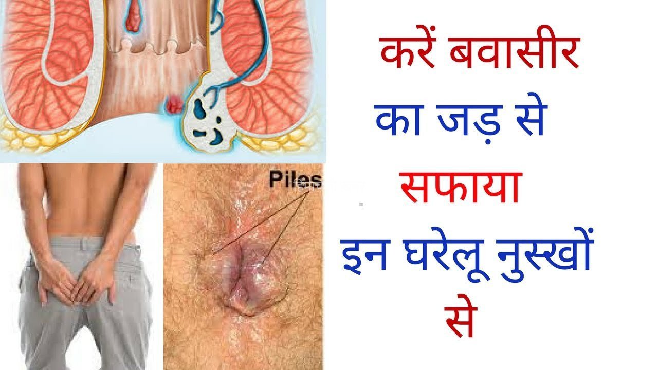 इन वजहों से होता है बवासीर ये है बचने के अचूक उपाय