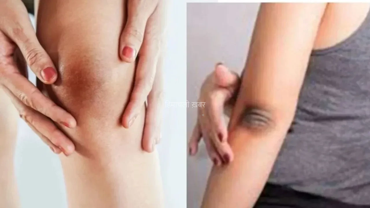 Skin Care Tips: कोहनी और घुटनों की जिद्दी कालापन से हैं परेशान? ये 6 घरेलू उपाय कर सकते हैं कमाल