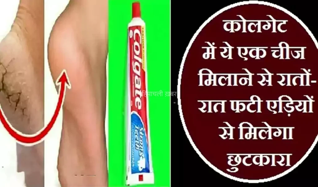 कोलगेट में ये एक चीज मिलाने से रातों-रात फटी एड़ियों से मिलेगा छुटकारा