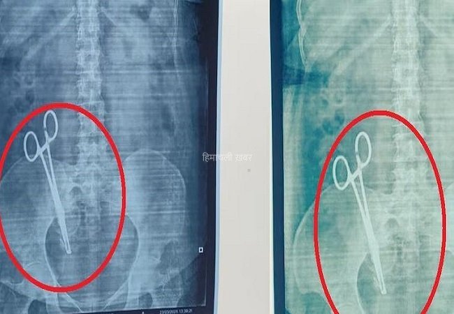 17 साल से पेट में दर्द से परेशान महिला का जब कराया गया एक्सरे, तो रिपोर्ट देख लोगो के उड़ गए होश​​​