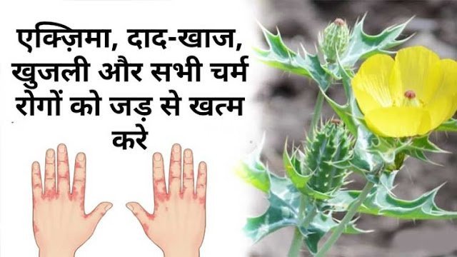 एक्जिमा, दाद खाज, खुजली और सभी चर्म रोगों को जड़ से ख़त्म कर देती है ये ट्रिक
