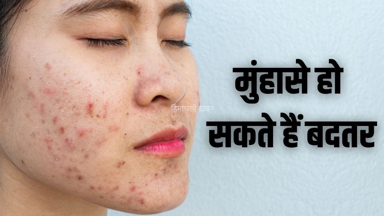 मुंहासों की समस्या हो रही ट्रिगर, आपकी रोज की ये 5 गलतियां हो सकती हैं वजह