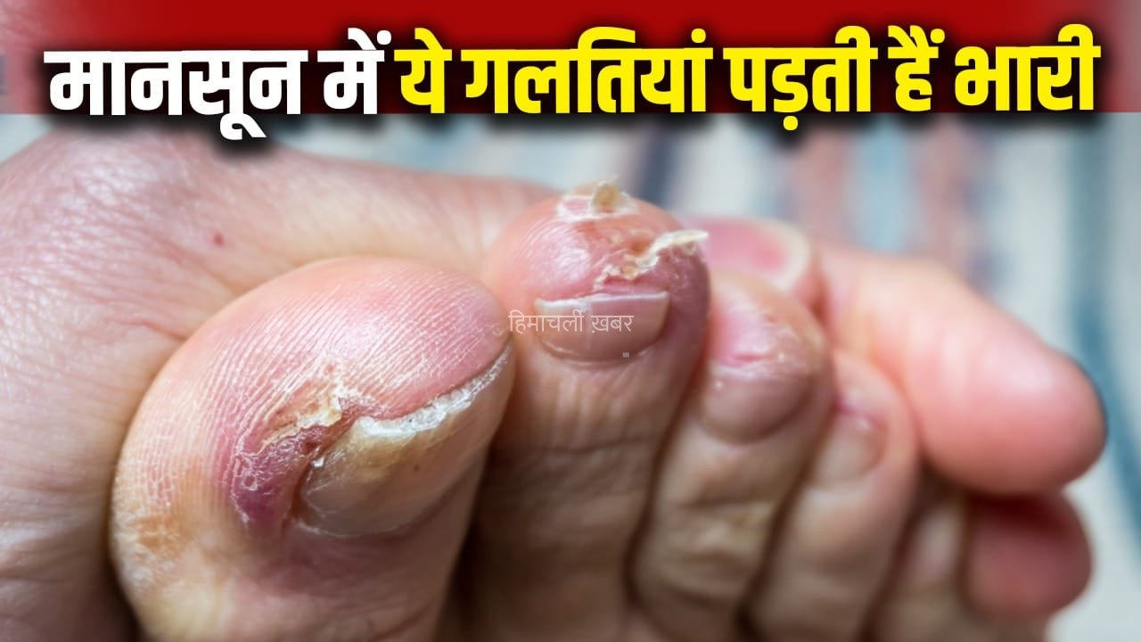 पैरों में हो सकता है फंगल इंफेक्शन, मानसून में ये गलतियां करने से बचें