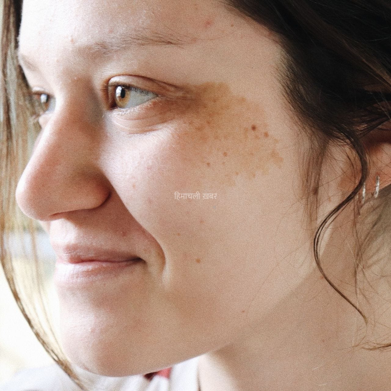 Pigmentation vs Tanning: पिग्मेंटेशन और टैनिंग में क्या अंतर है? डर्मेटोलॉजिस्ट से जानें​
