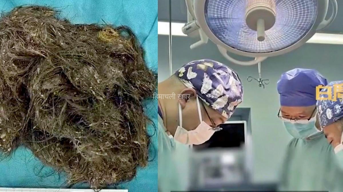 15 साल की लड़की के पेट से निकला 2Kg का बालों का गुच्छा, 6 साल से खा रही थी अपने हेयर​​​