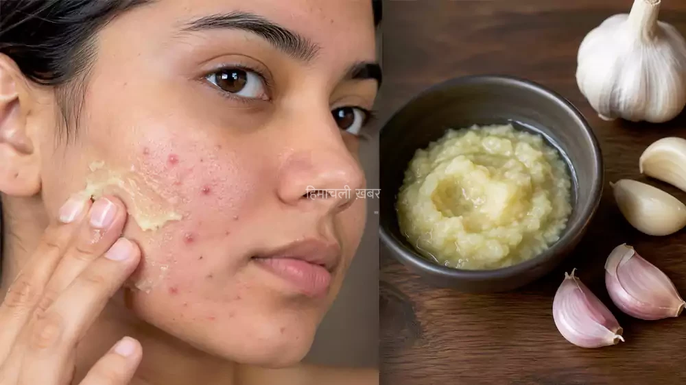 lahsun pimple