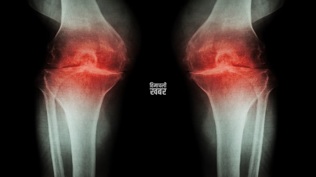 knee-osteoarthritis